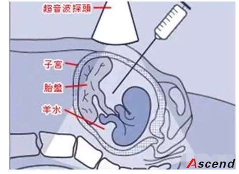 唐筛、无创DNA、NT三者有什么区别？